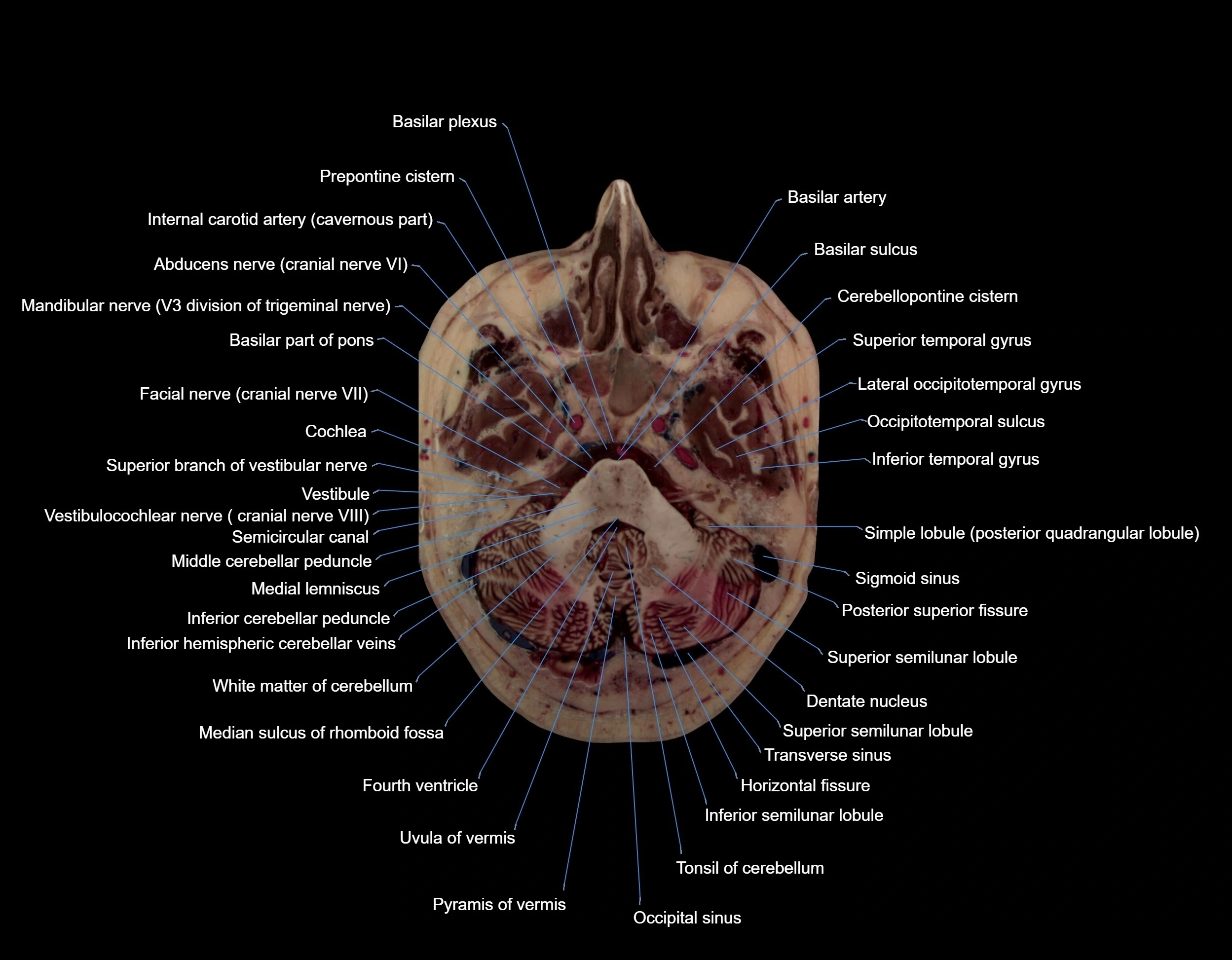 MRI Brain axial cross sectional radiology anatomy 3T image  -img-000018.webp